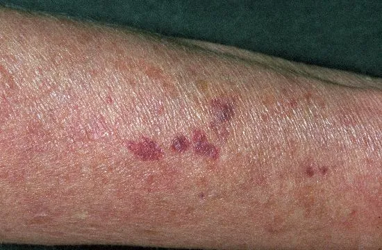 DermIS - Purpura Steroidica Corticoid Damage (image)