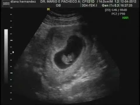 El primer Ultrasonido de nuestro bebe 9 Semanas - YouTube