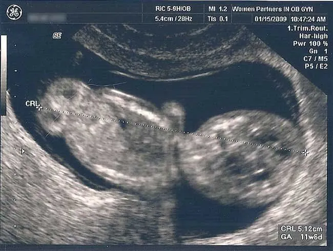 El ultrasonido temprano en el embarazo