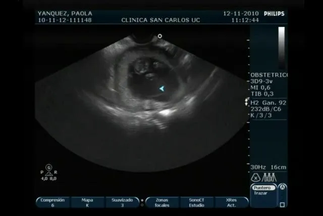 11 SEMANAS 6 DIAS ECOGRAFÍA DE PAO Y AGUS on Vimeo