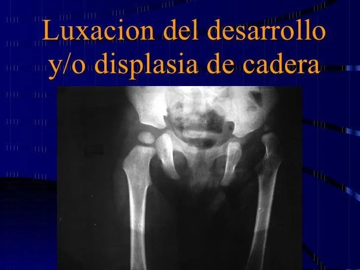 4.ecografia de cadera