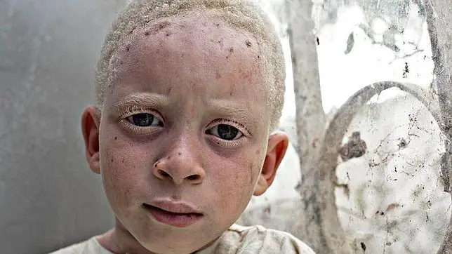 Los africanos albinos, una condena grabada en la piel - ABC.es