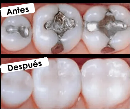 AIXA Tiene de todo un poco: Resinas Compuestas en la Odontología ...