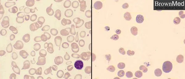 Alpha thalassemia