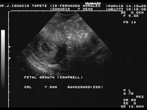 7 semanas de embarazo ultrasonido - Imagui