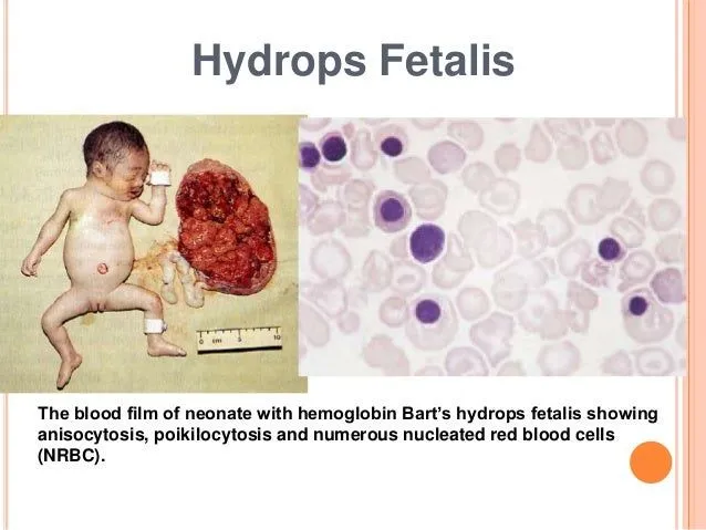 Approach to hemolytic anemia naglaa