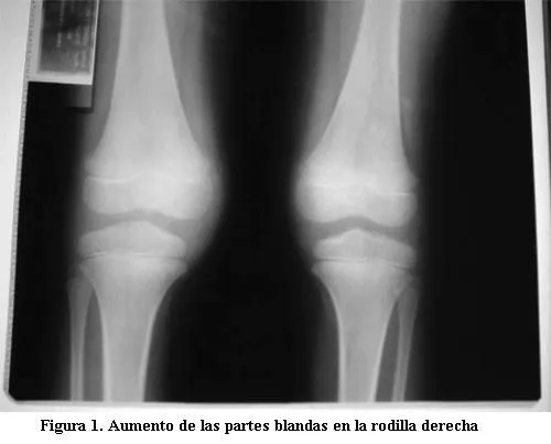 Archivos de Pediatría del Uruguay - Hematuria e hipercalciuria ...