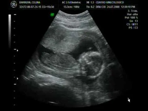 Nuestro Bebe a las 15 semanas - YouTube