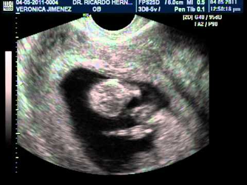 Mi Bebe a las 8 semanas de gestacion - YouTube