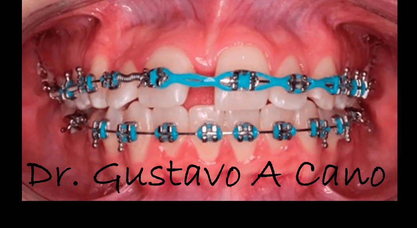 Blog de ortodoncia en fotografías - Orthodontic pictures