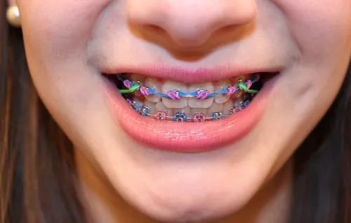 Braces Colors: Braces Colors Christmas Ideas For Guys