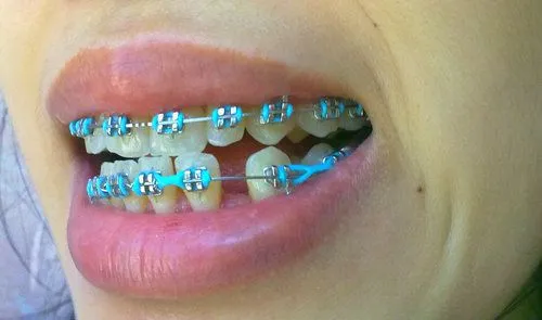 Braces Colors: Halloween Braces Colors