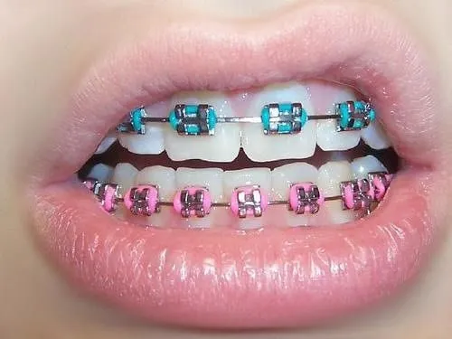 Braces Colors: Kid Braces Colors Brackets