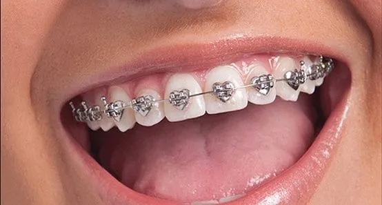 Braces on Pinterest | Braces Colors, Fake Braces and Heart