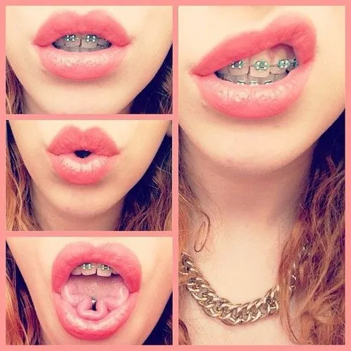 Braces/Retainer on Pinterest | Braces Colors, Braces and Pink Braces