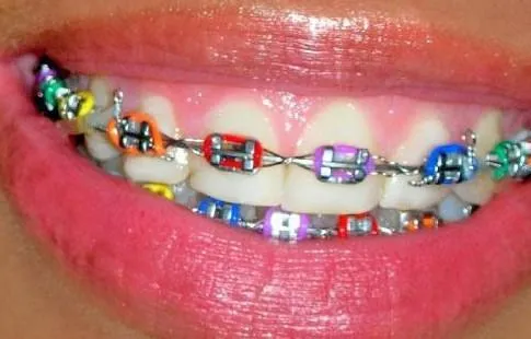 Brackets de colores - Imagui