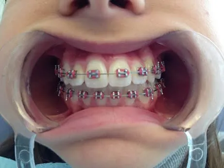 Pueden los brackets pueden dañar el esmalte dental? - Yahoo Noticias