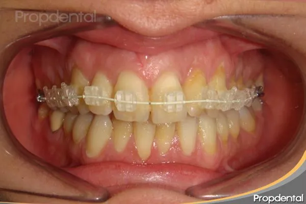 Brackets estéticos | Preguntas y caso clínico de ortodoncia