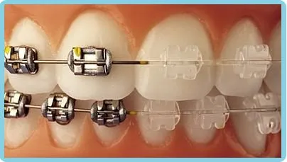 brackets-esteticos.jpg