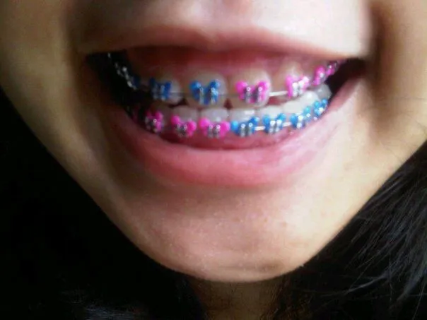 Brackets ligas de Mickey Mouse - Imagui