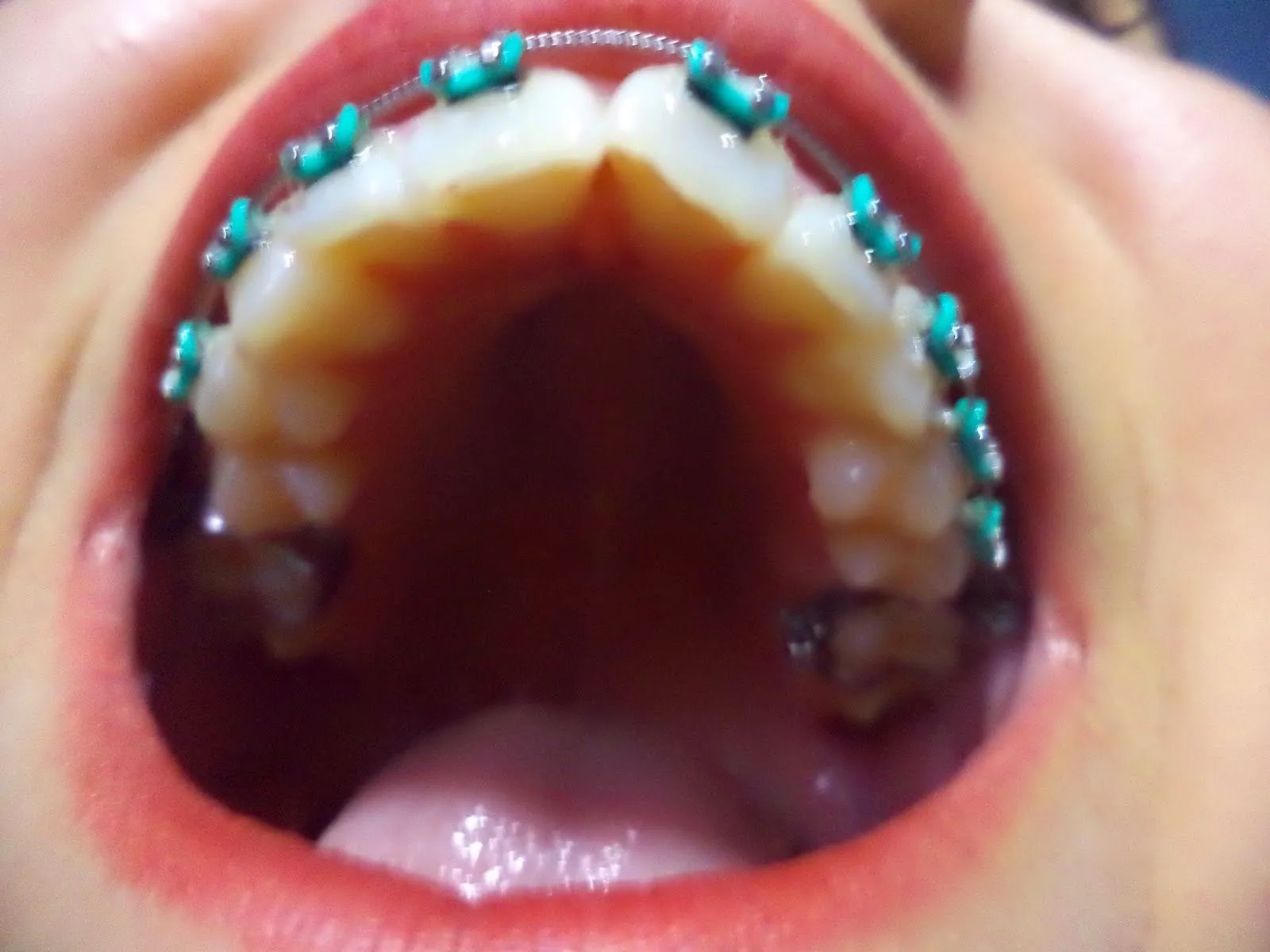 Mis Brackets: Paso a Paso [Mi experiencia]