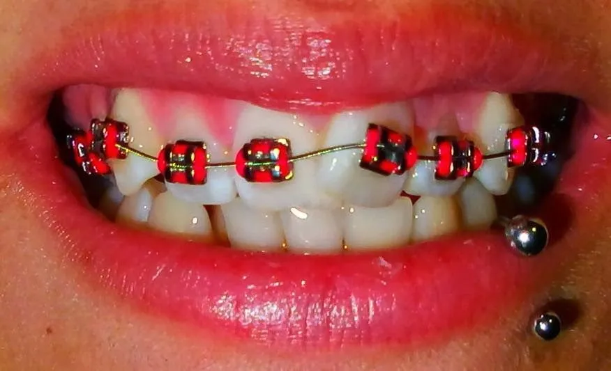 Mis Brackets: Paso a Paso [Mi experiencia]