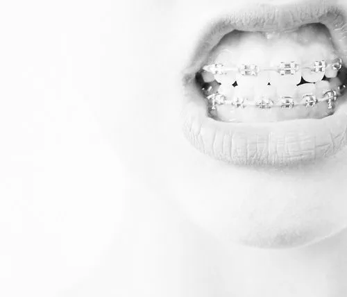 Sσnrie αunque duelα«3: Experiencia con los brackets :