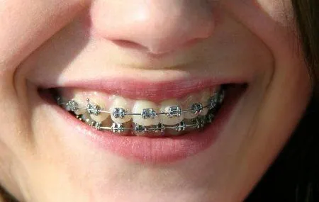 Brackets colores - Imagui