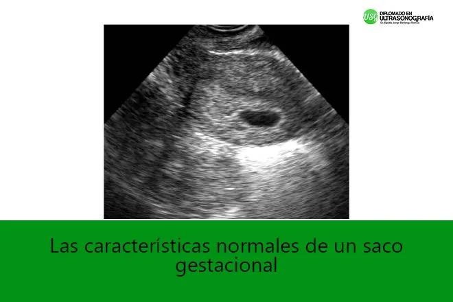 Las características normales de un saco gestacional | Diplomadomedico.