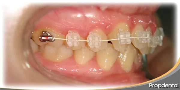 Caso clínico brackets de zafiro | Ortodoncia estética