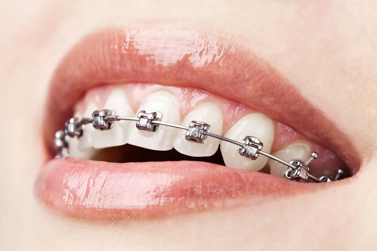 Cómo cepillar los dientes con brackets