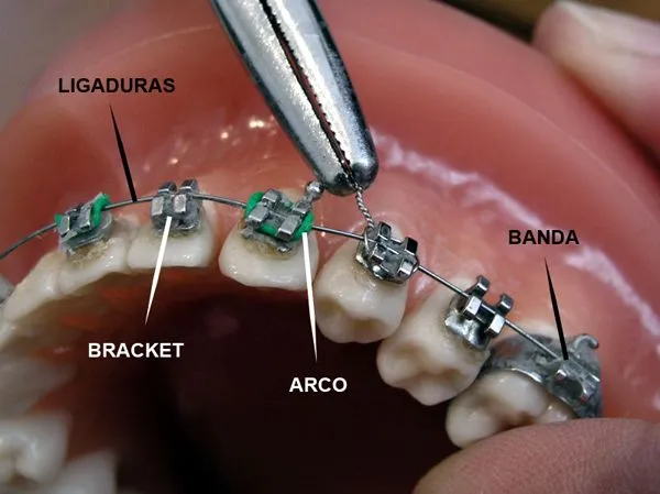 Clinica Dentis Implant: junio 2013