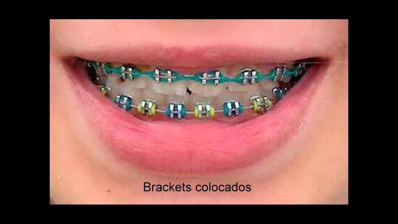 Colores de brackets para hombre - Imagui