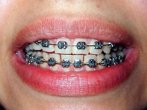 Color de brackets de moda - Imagui