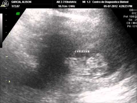 CORAZON DE UN FETO DE 2 MESES - YouTube