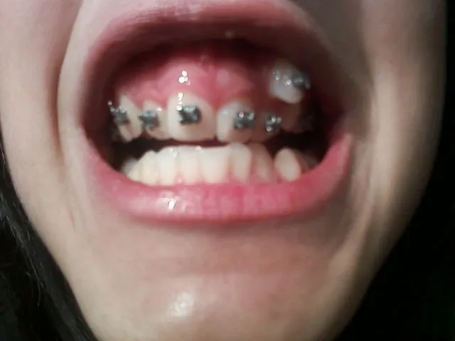 Mis Dientes :D: Los Brakets