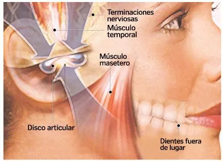 Dientes que rechinan | Salud | La Revista | EL UNIVERSO