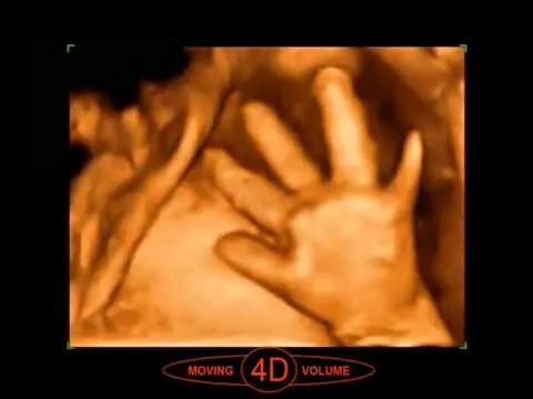 Diferencias entre Eco 2D y la imagen 3D y la Eco 4D - YouTube