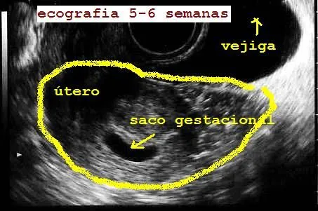 dudas gine: Ecografía en el embarazo