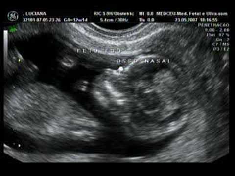 Eco 12 semanas - YouTube