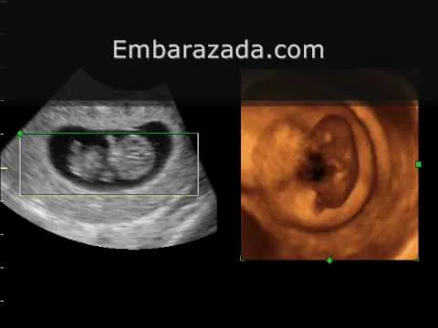 Eco 4D bebe 10 semanas - YouTube