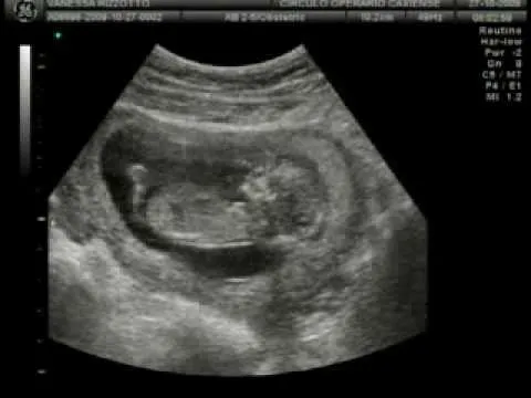 ECOGRAFIA 13 SEMANAS - translucencia nucal - YouTube