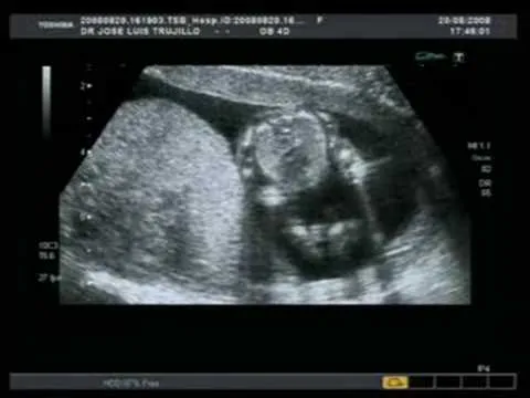 Ecografía 15 semanas niña - Imagui