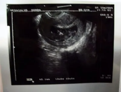 Nuestro Bebe: Ecografías.