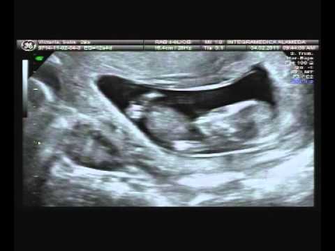 Ecografía de bebe 3 meses - YouTube