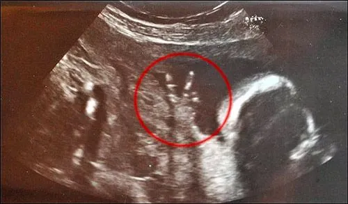 Ecografía curiosa: bebé pacifista