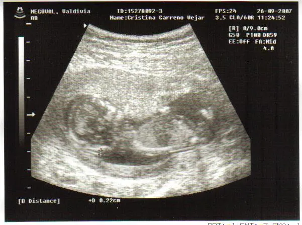 Eco de 5 meses - Imagui