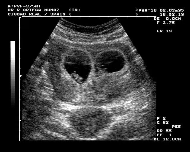 Ecografia gemelar de 5 semanas - Imagui