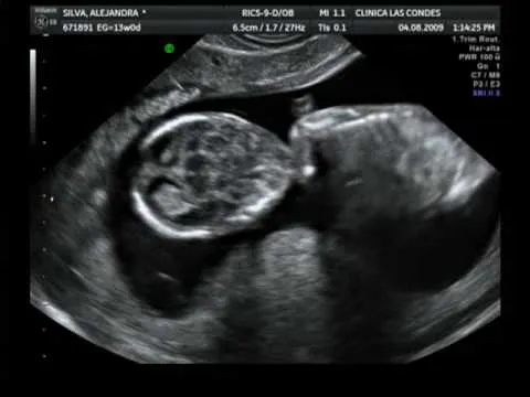 Ecografía semana 13 - YouTube