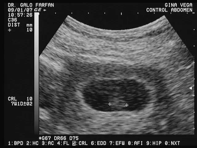 Ecografia 7 semanas de embarazo - Imagui